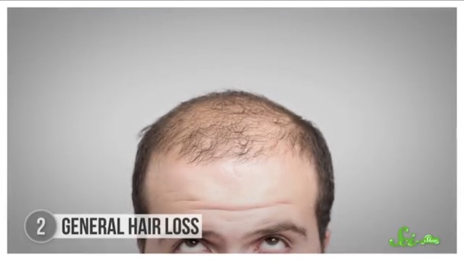 ハゲる 毛深くなるのはなぜ 健康について あなたの髪が教えてくれる5つのこと ログミーbiz
