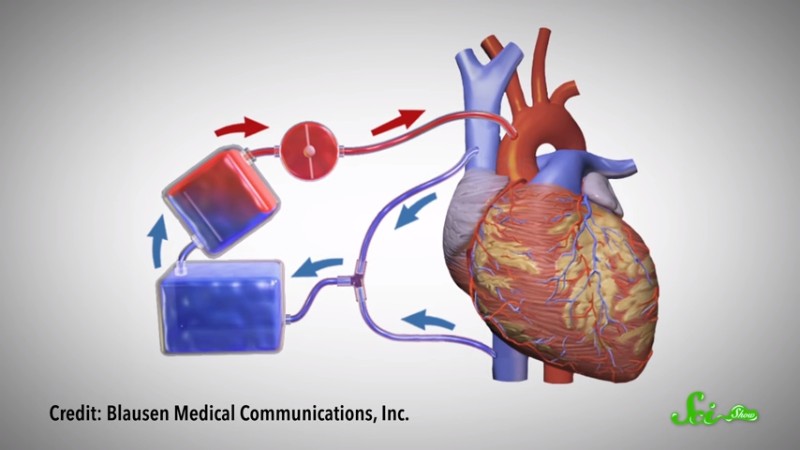 多くの命を救った人工心肺は、どんな進化を遂げてきたか - ログミーBiz